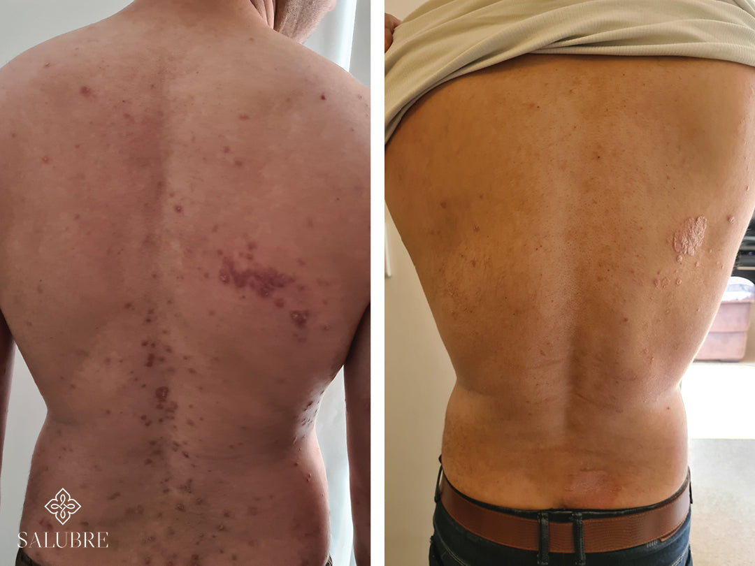 Guttate psoriasis patient before and after treatment