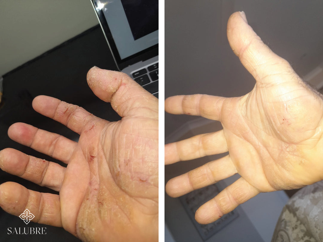 Before and after images of a palmoplanter psoriasis patient