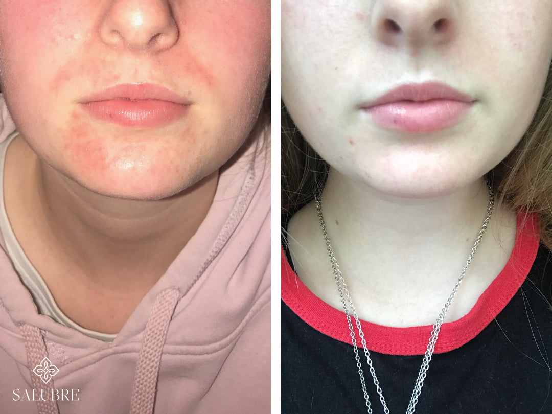 Dermatitis patient before and after images