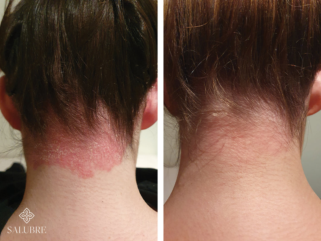 Plaque psoriasis before and after treatment images 
