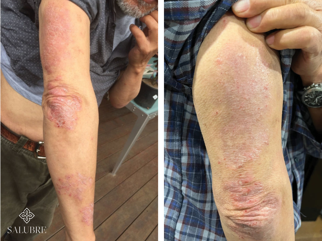 Psoriasis patient before and after images