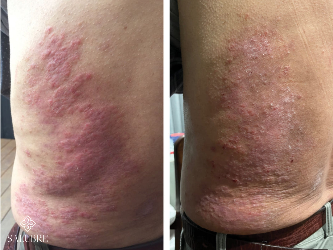 Before and after treatment images of psoriasis pateint