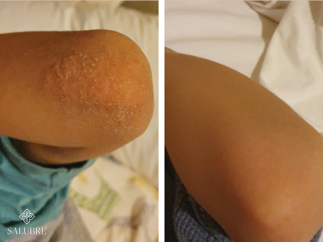 Before and after image of a psoriasis patient