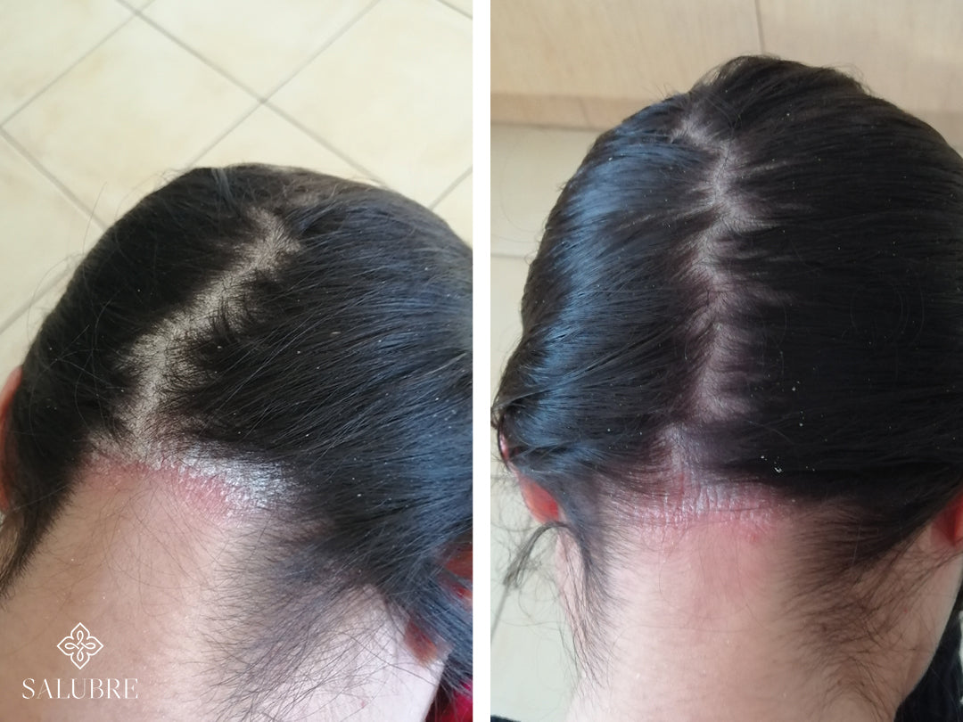 Before and After images of a scalp psoriasis patient
