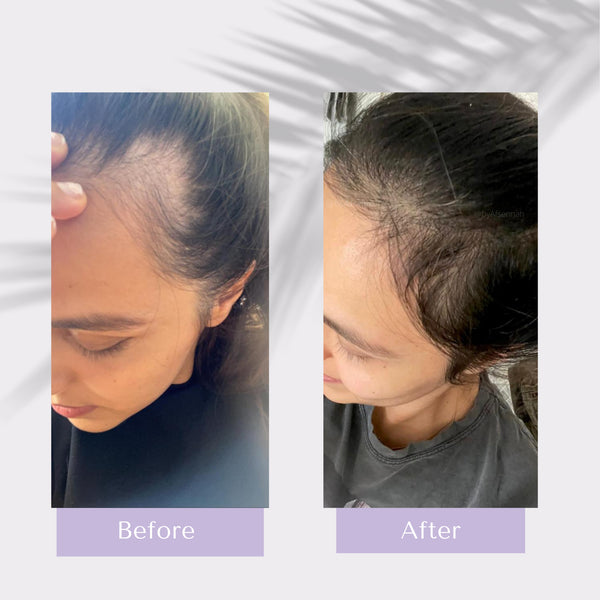 Before and after photo of a woman's hair growth transformation from fine and thin to full and thicker with the use of our hair growth products