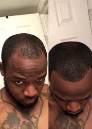 Before and after photo of a man's hair growth results after using our hair growth products for 6 months