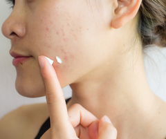 a young lady with acne applying a treatment cream