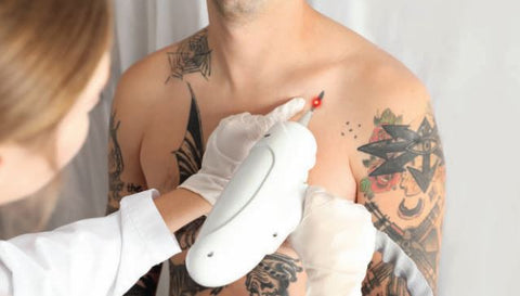 Pico Lasers Tattoo Removal