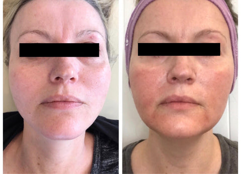 halo laser before and after photos