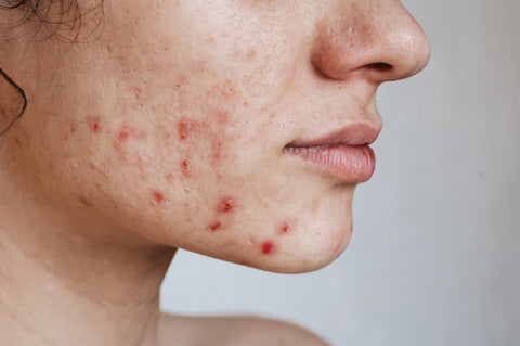 Close up of woman with breakout on face