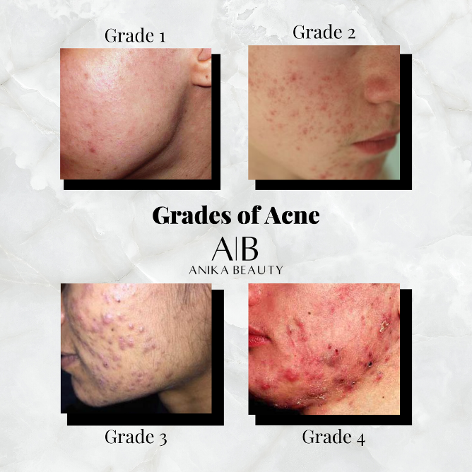 Teresa Paquin Acne And The Different Grades From One To Four How Can An Aestheticia You Have All Probably Had Or Heard Of Acne At Some Point In Your Life But What