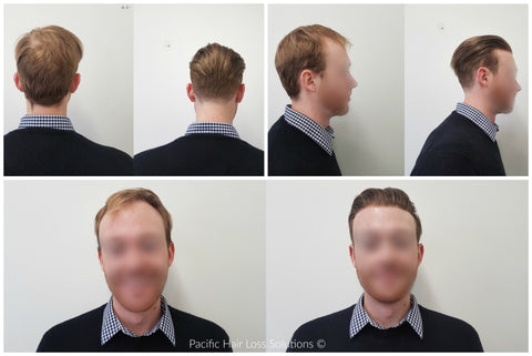 young male pattern baldness hair piece solution vancouver