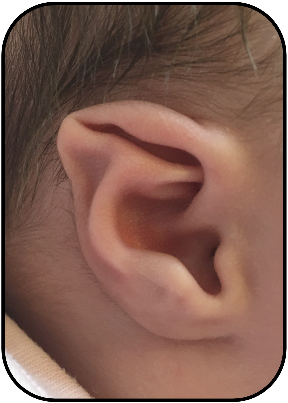 baby with inverted ear