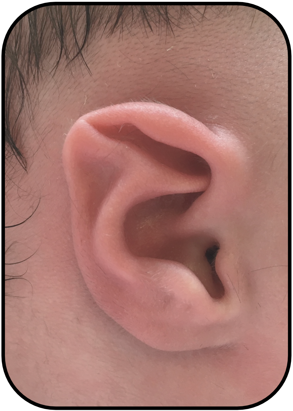 baby ear during ear buddies