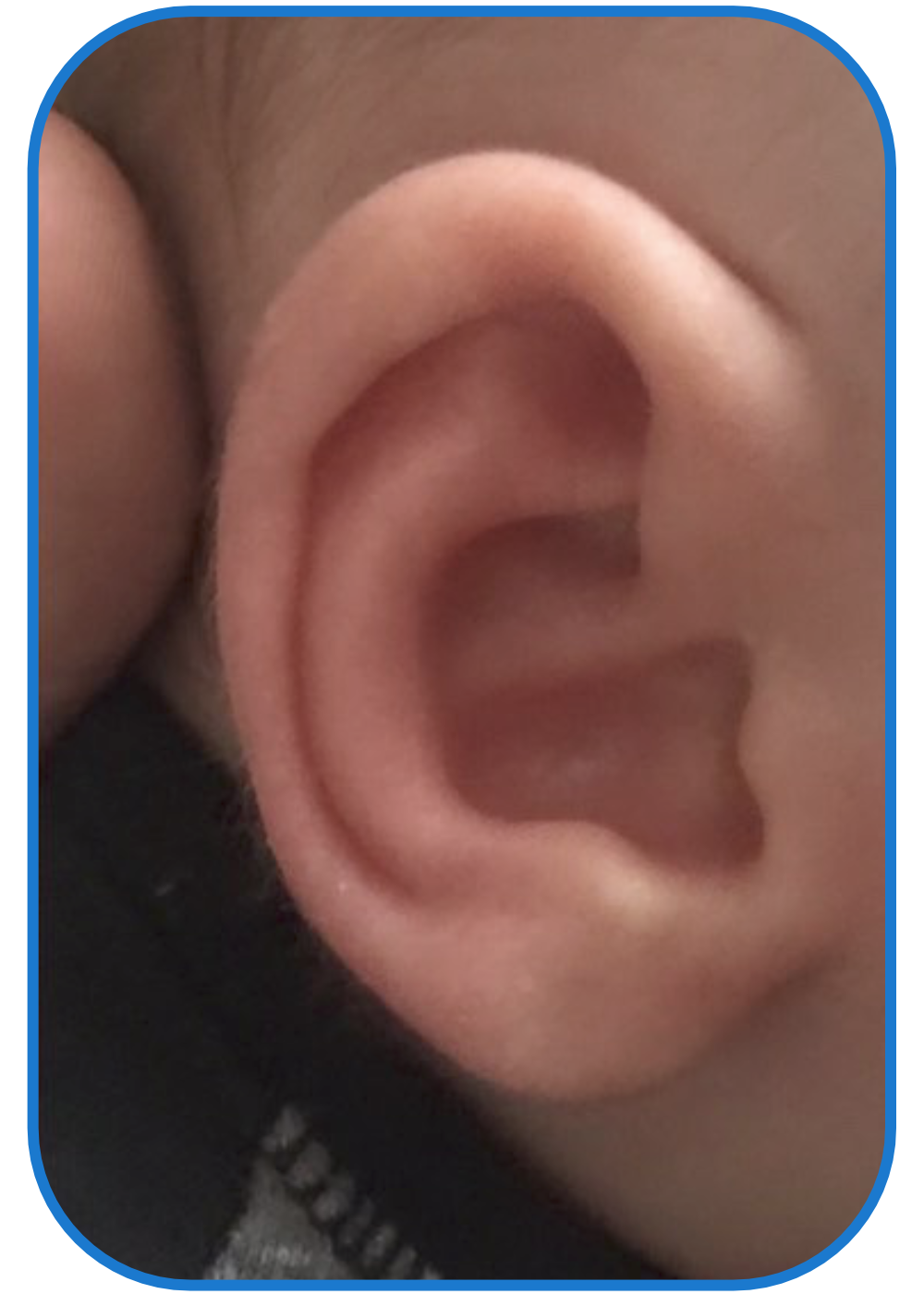 ear buddies parent Conchal crus ear treatment