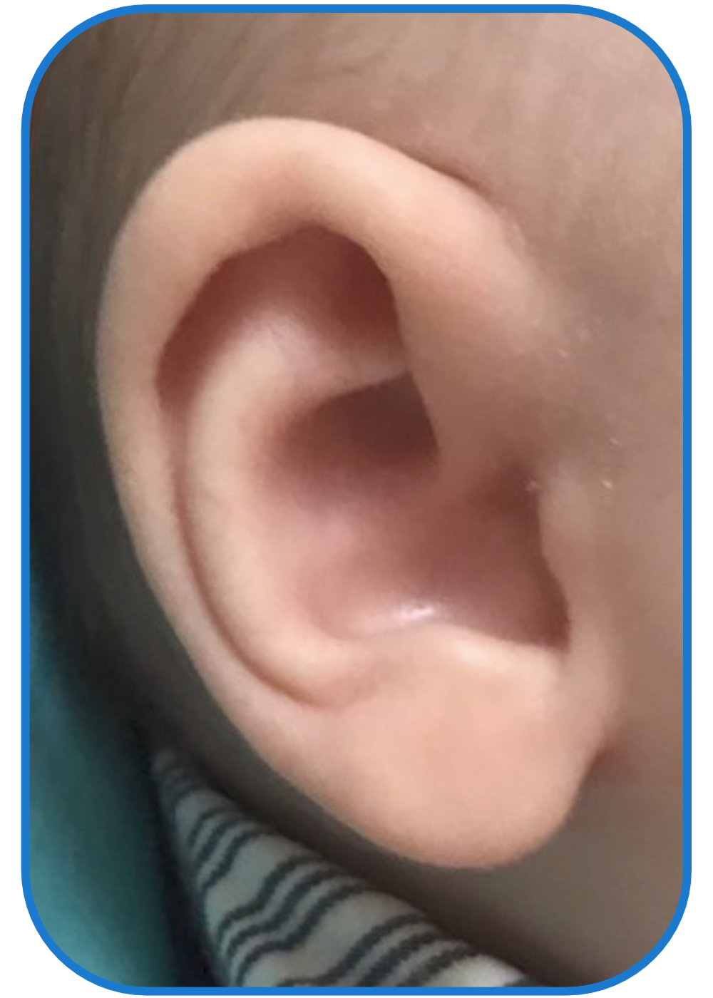 corrected baby ear Conchal crus