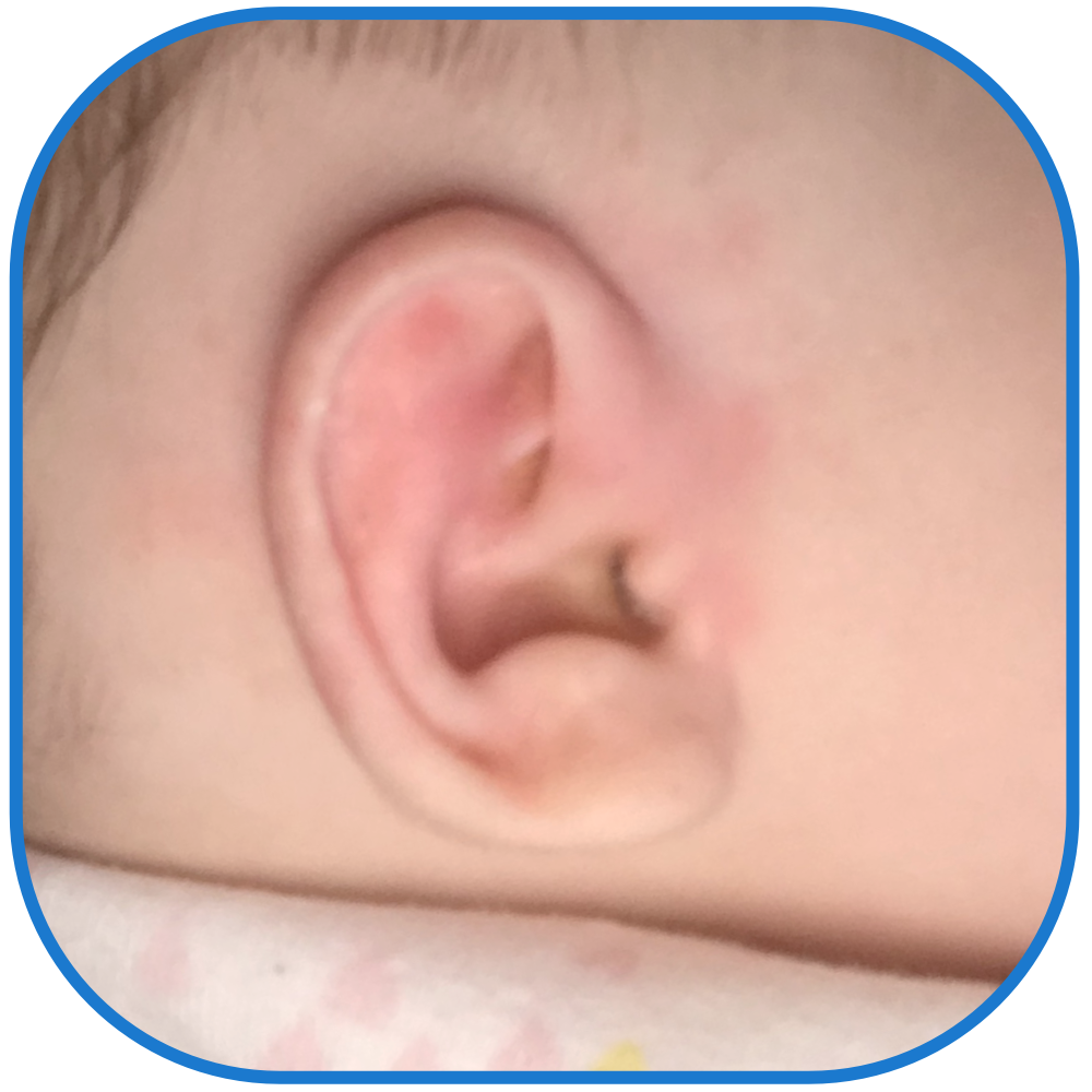 corrected elf ear result in baby ear
