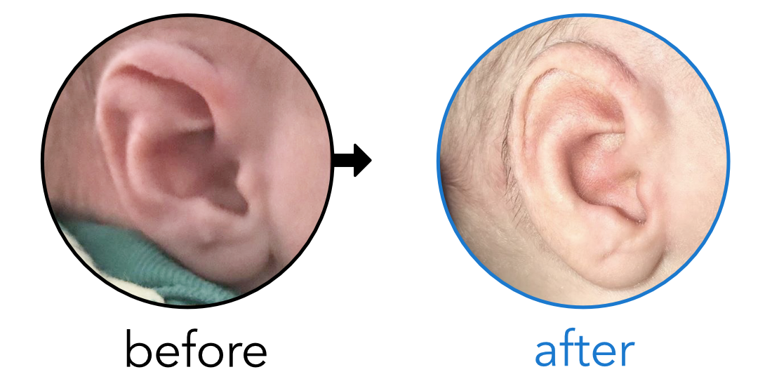 baby's ear folded over - stahl's ear
