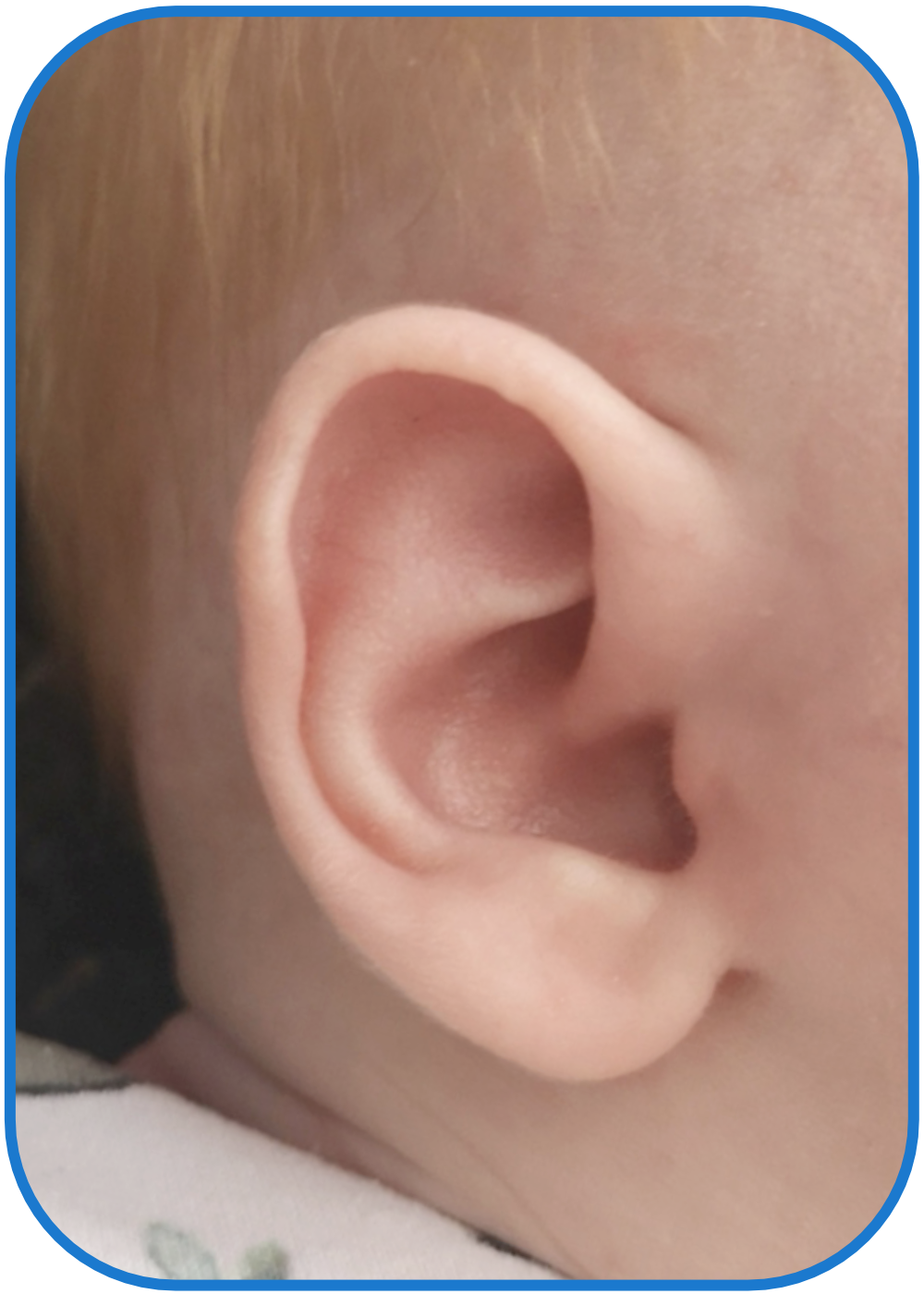 Folded Over Ears can be Fixed without Surgery