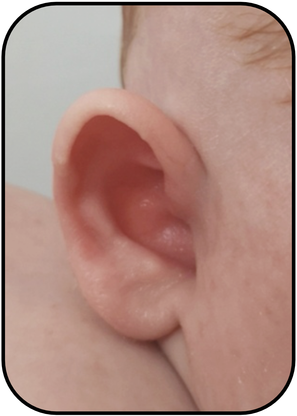 Baby's Ear folded over