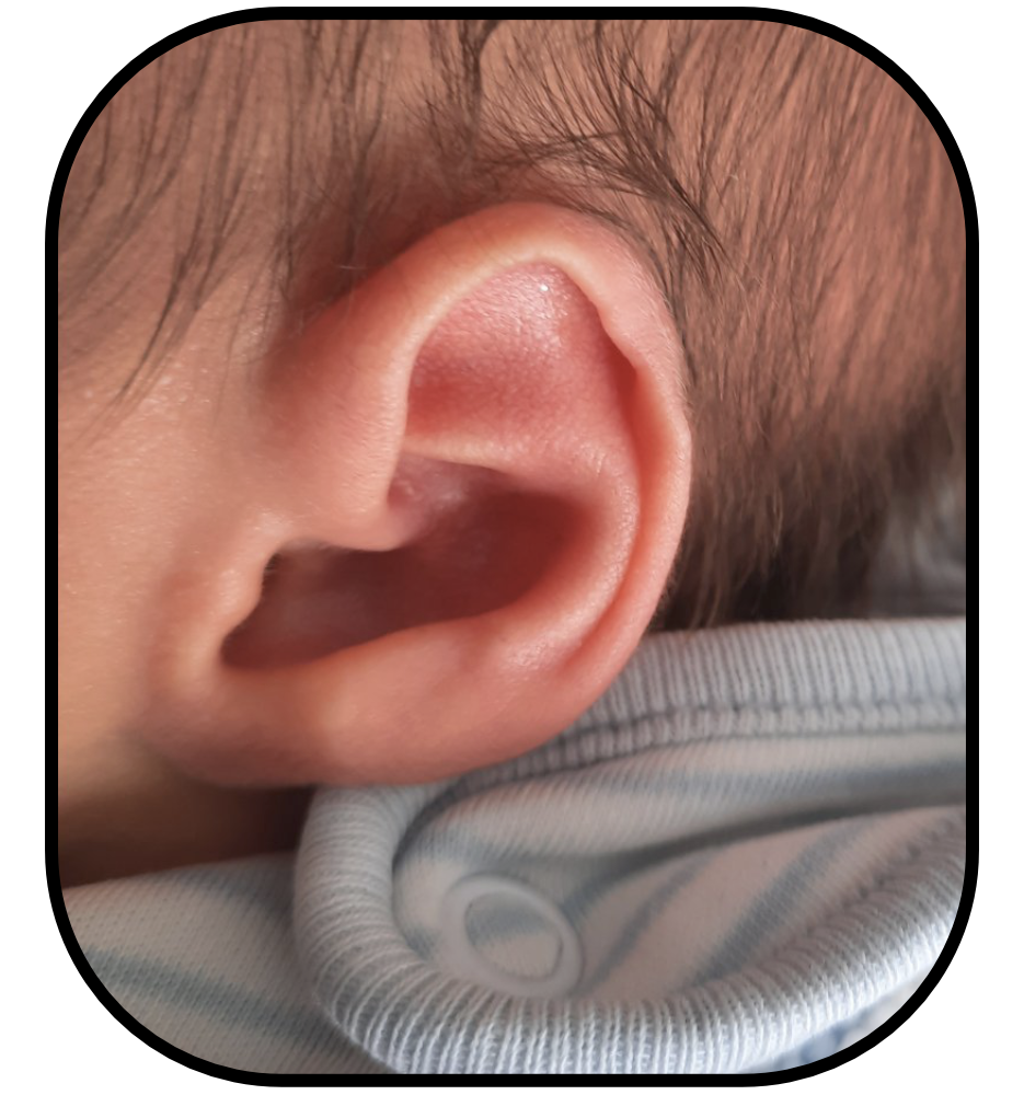 Baby's Ear folded over