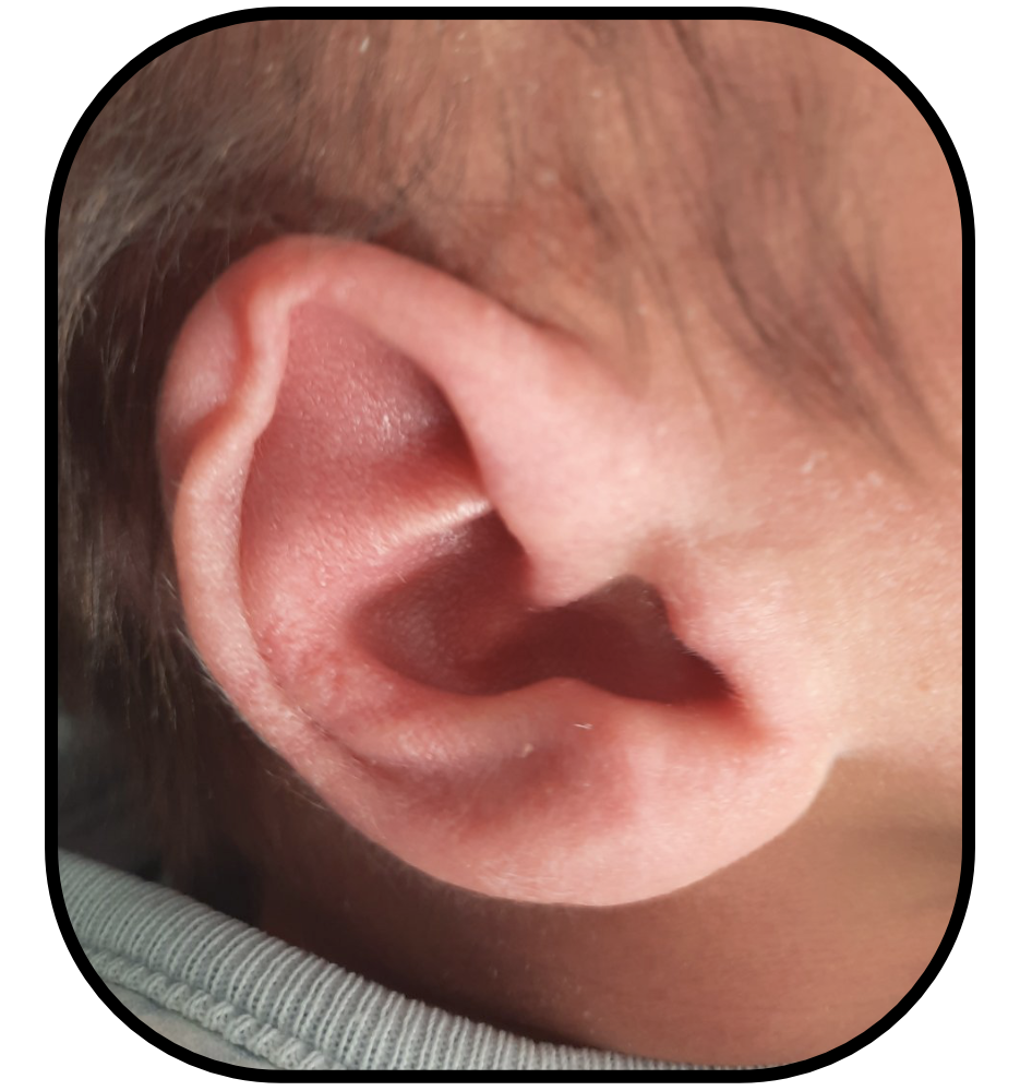 Folded Over Ears can be Fixed without Surgery