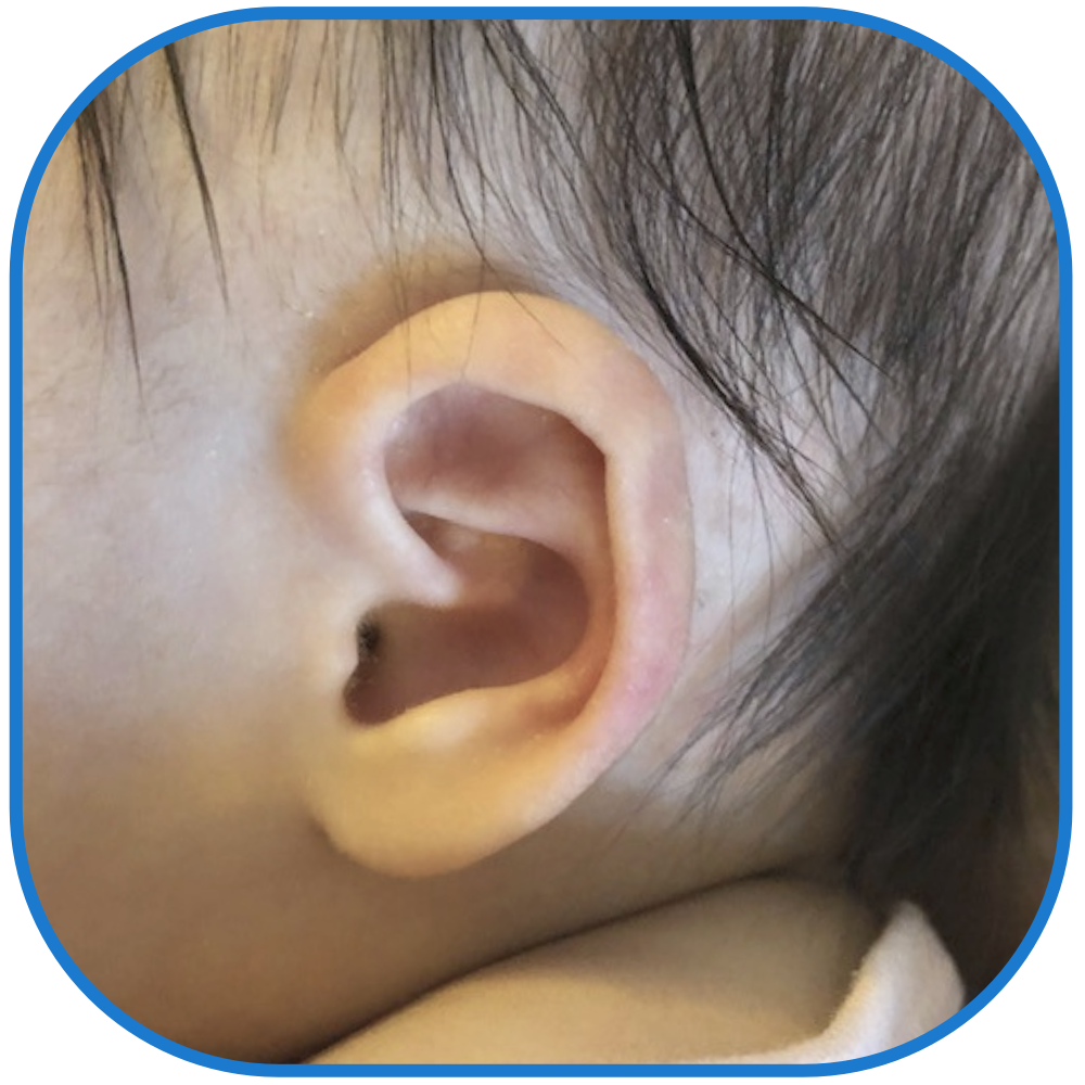 ear buddies parent solution after