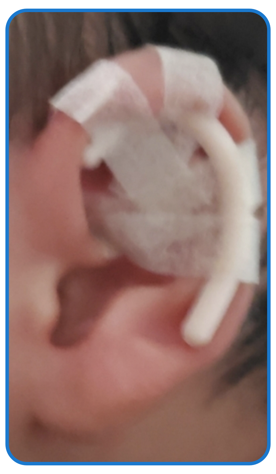 baby ear treatment ear buddies