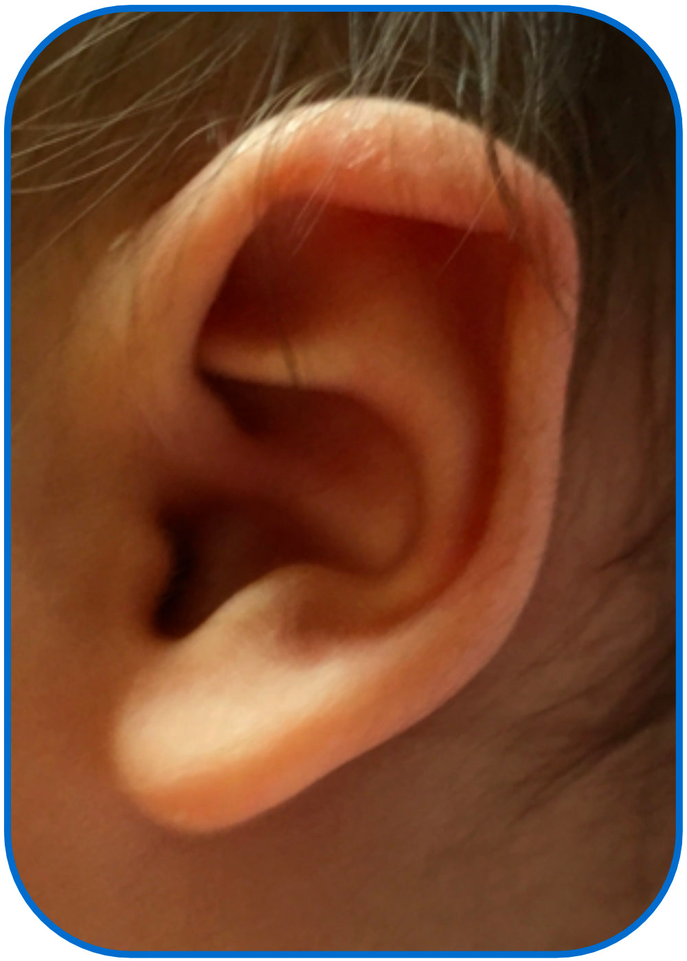 corrected baby ear usa parent story
