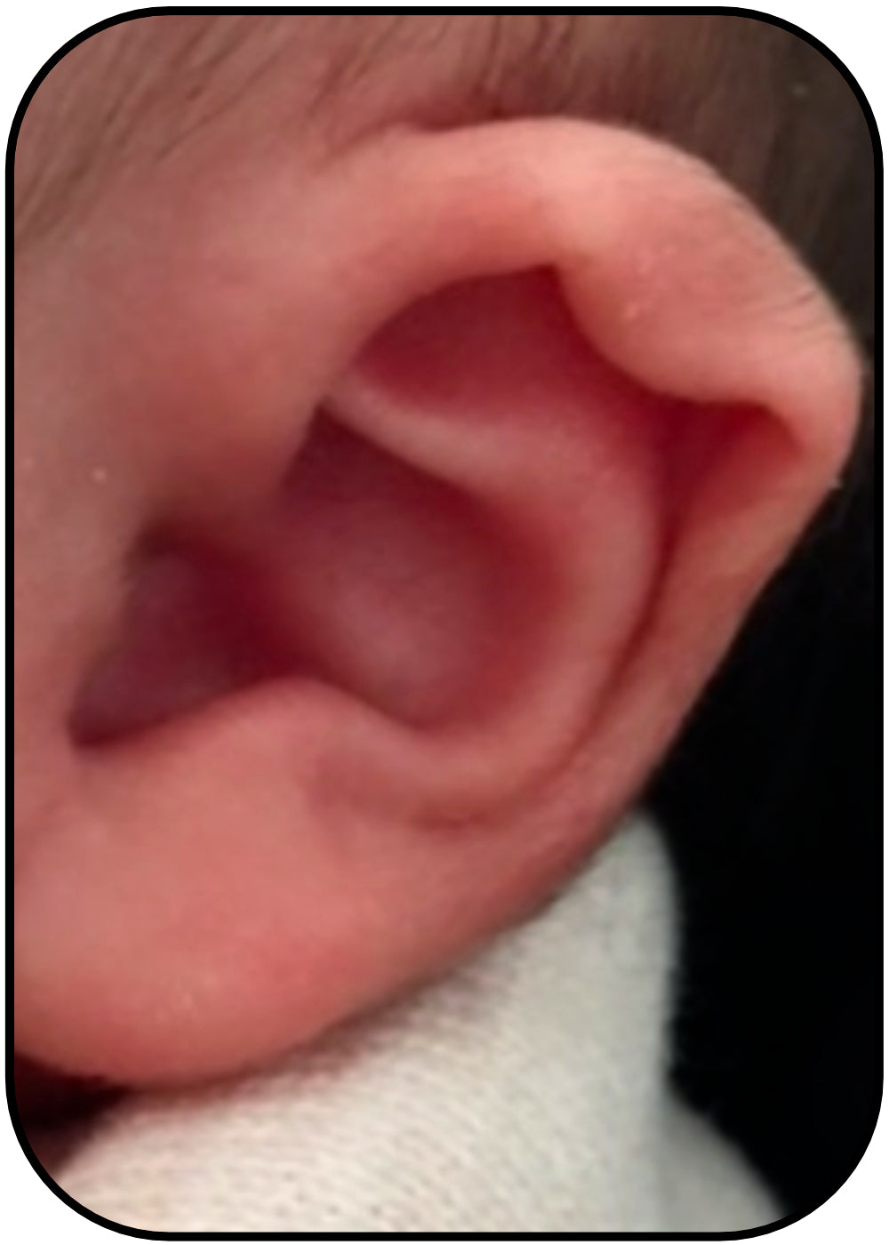bend in babies ear