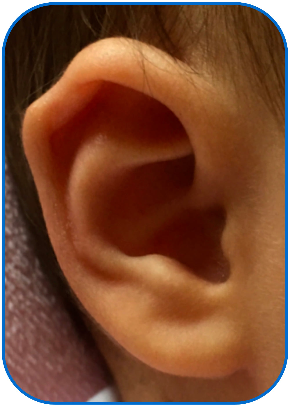 corrected kink in baby ear