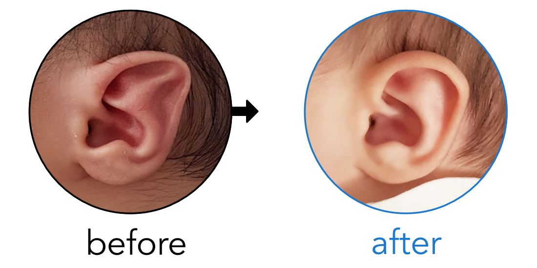 stahl's bar baby ear