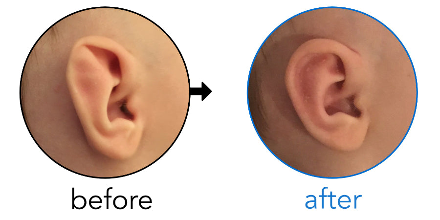 Stahl's ear deformity in a baby fixed by ear buddies
