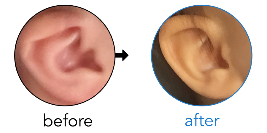 folding top of baby ear