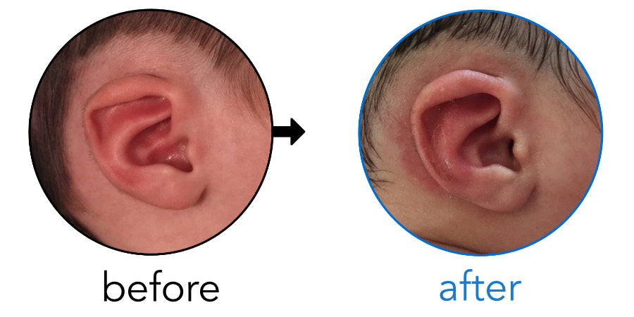 top of ear folding over solution
