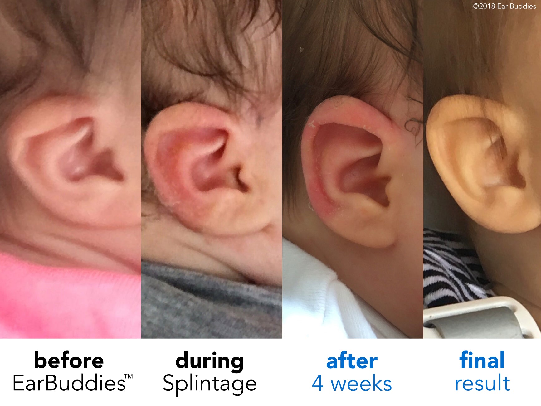 folded ear problem in baby ear
