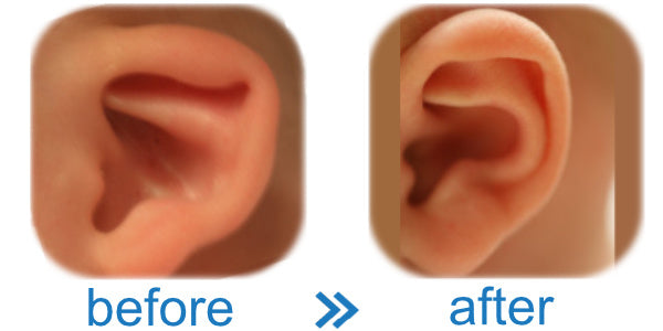 Picture of a Cup Ear Worried Baby's ears are cupped and want to fix them before and after results here!