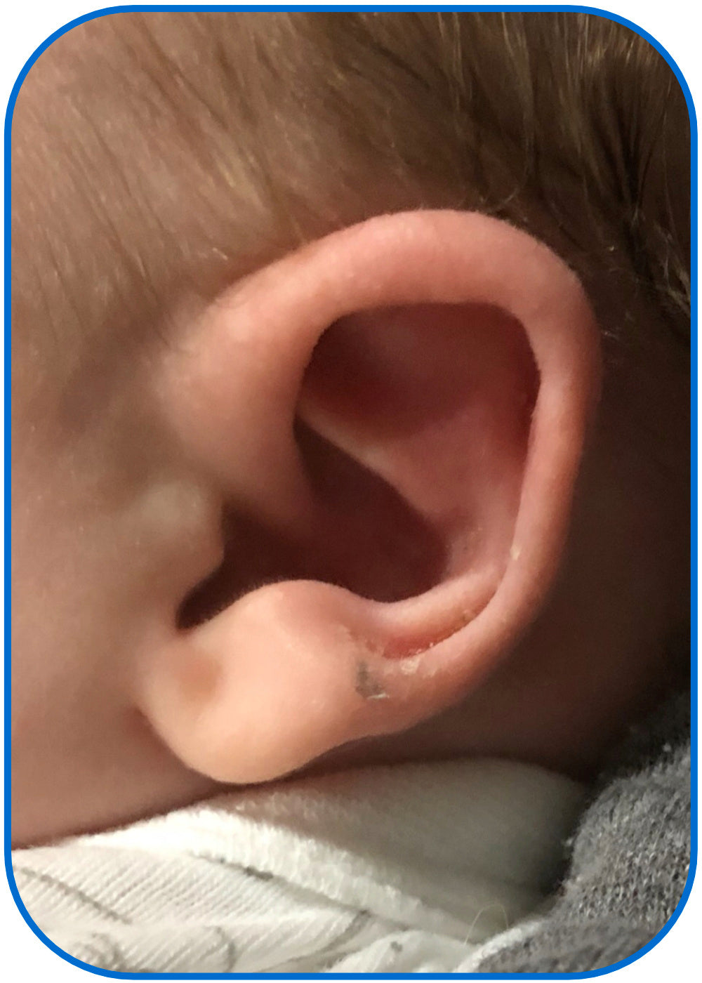 baby ear fixed with no surgery