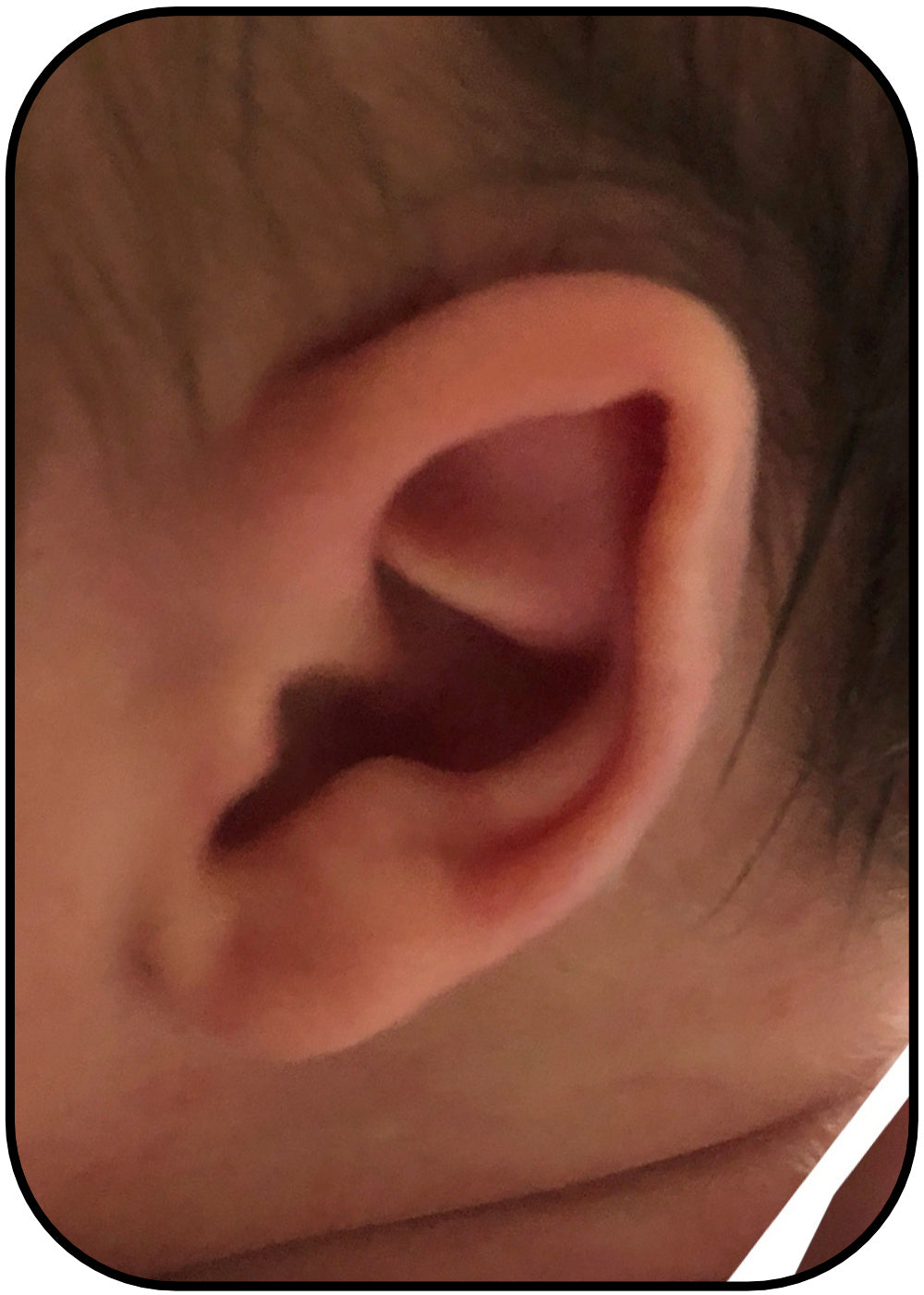 baby right ear deformity