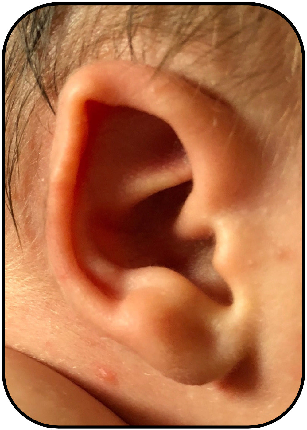 baby ear folded ear deformity before ear buddies
