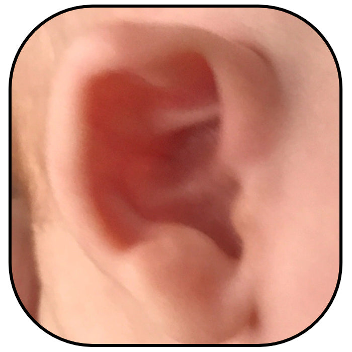 baby ear with stahl's bar Spock deformity