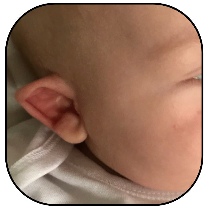 baby ear with stahl's bar Spock deformity