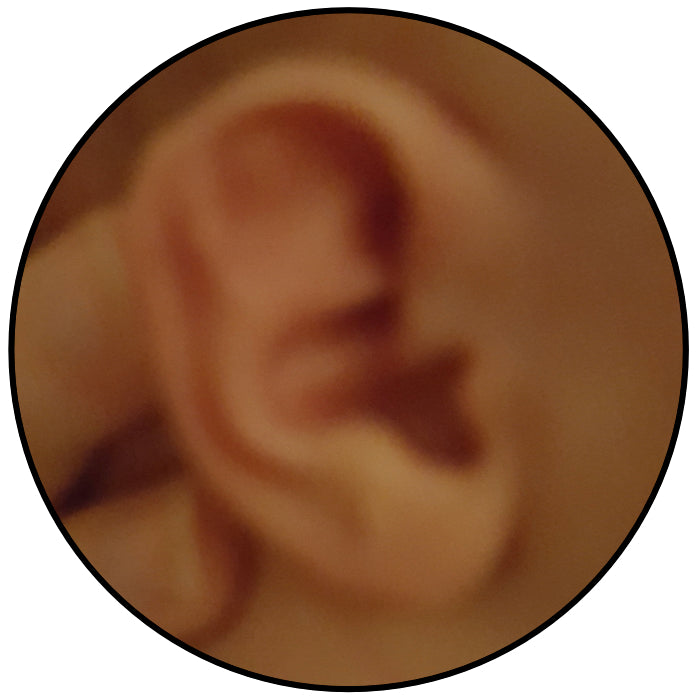 baby's ear cartilage folded