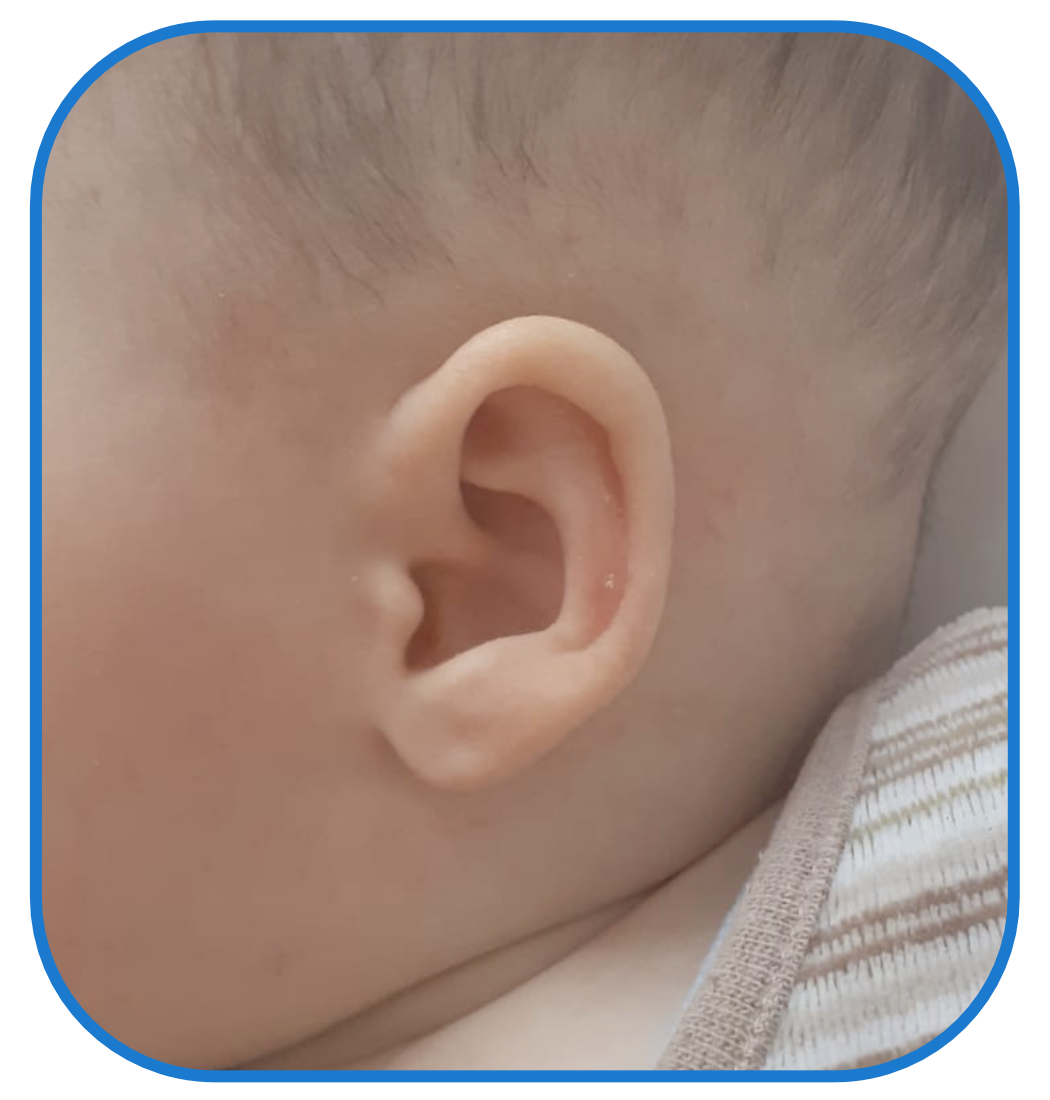 Baby Ear Lobe Sticks Out - Review of EarBuddies