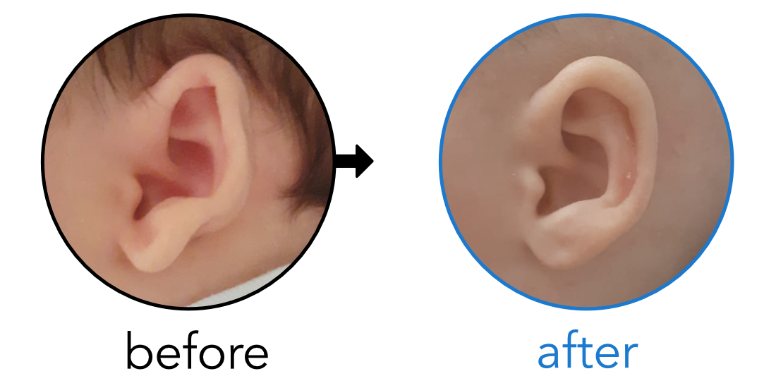 baby's ear lobe sticks out