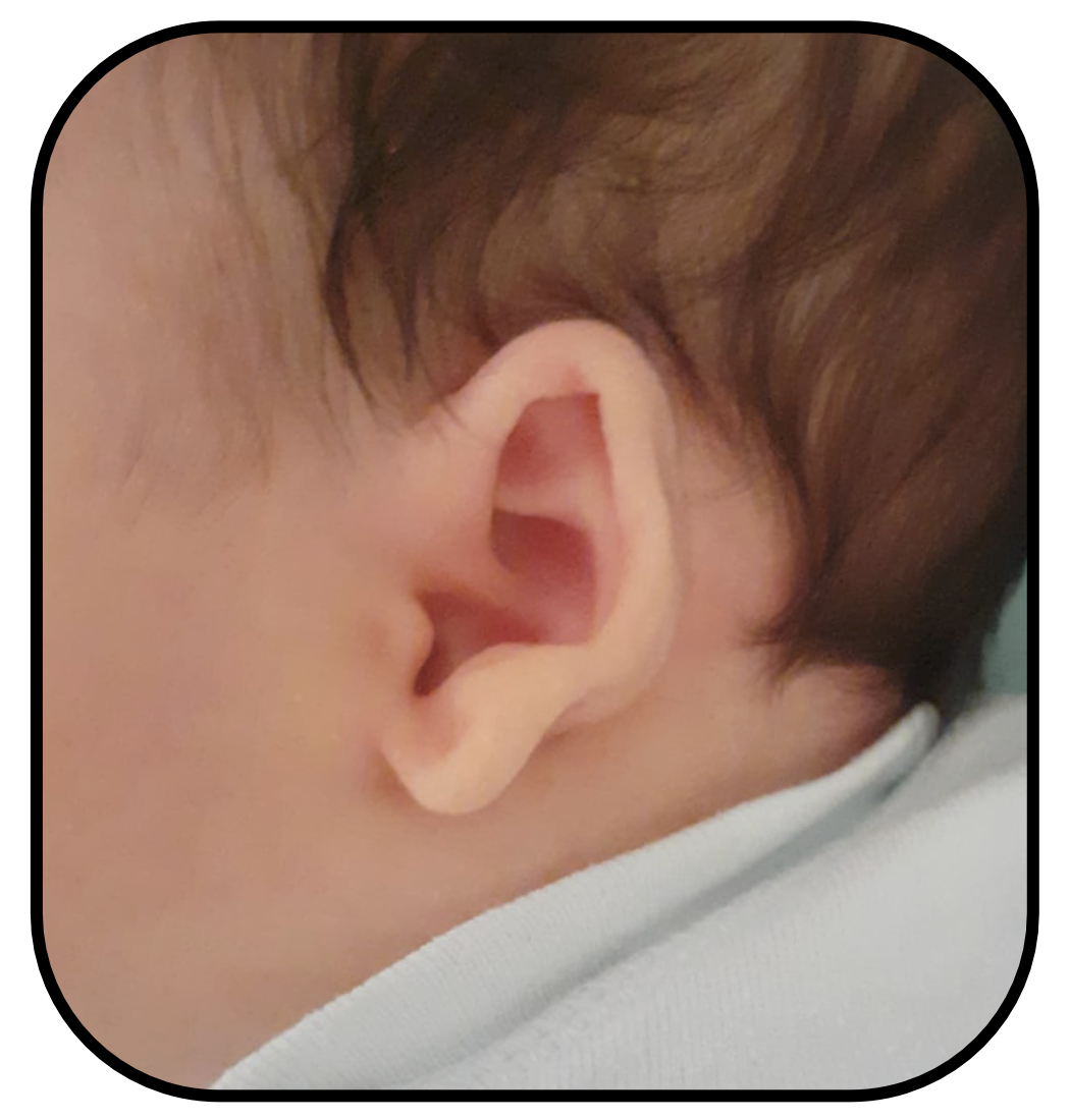 Baby Ear Lobe Sticking Out