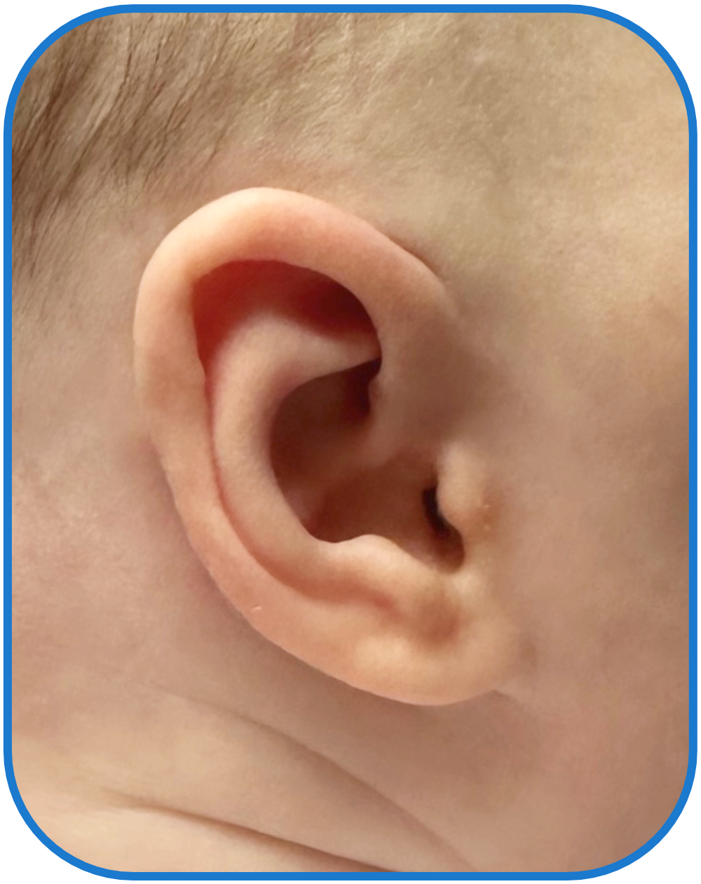 ear buddies conceal crus ear solution