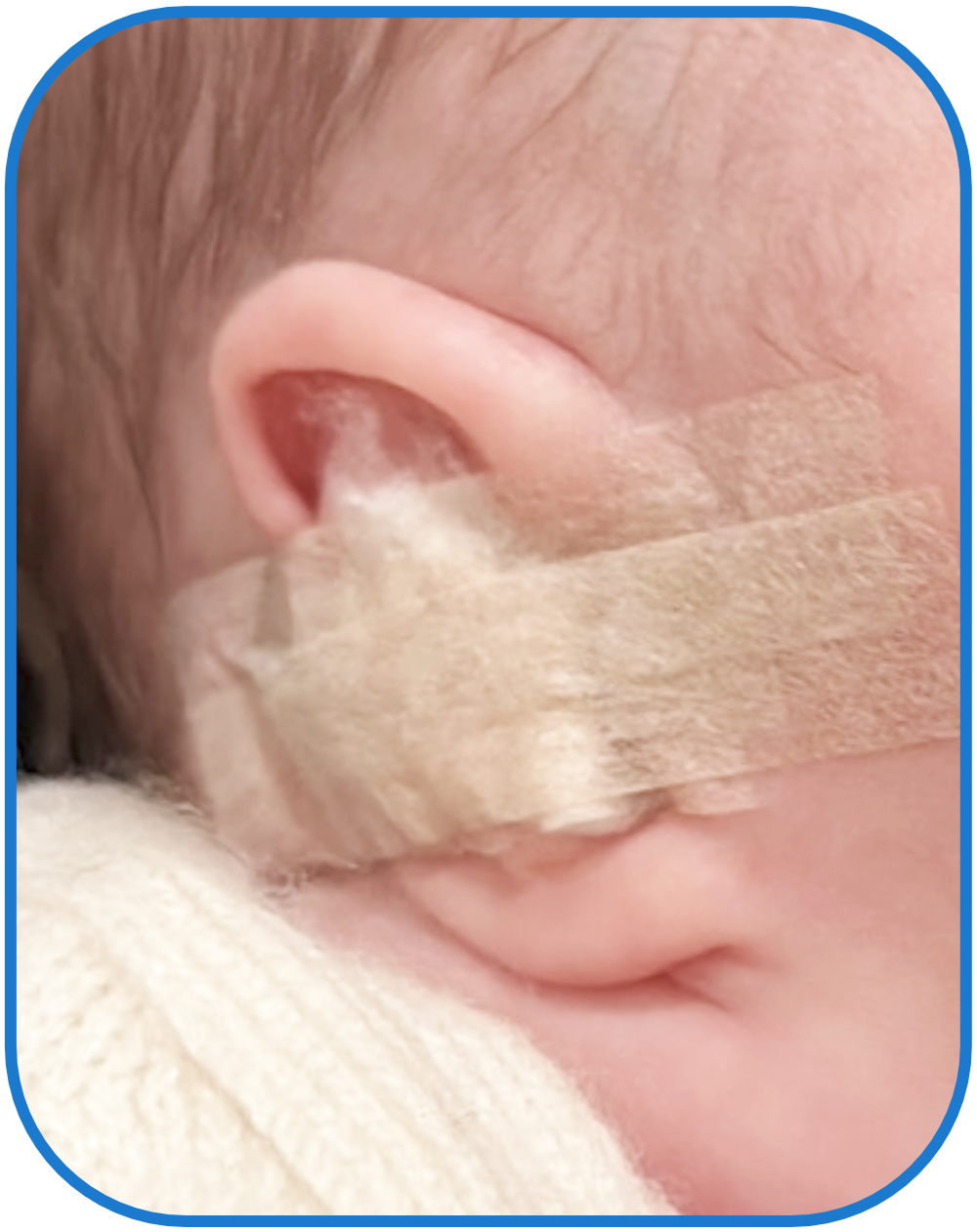 ear buddies device fitted