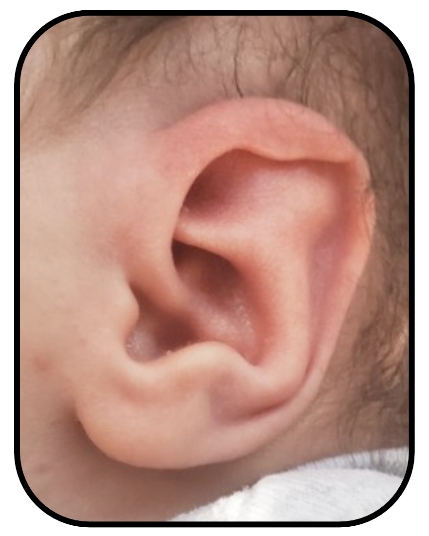 babys ear before ear buddies