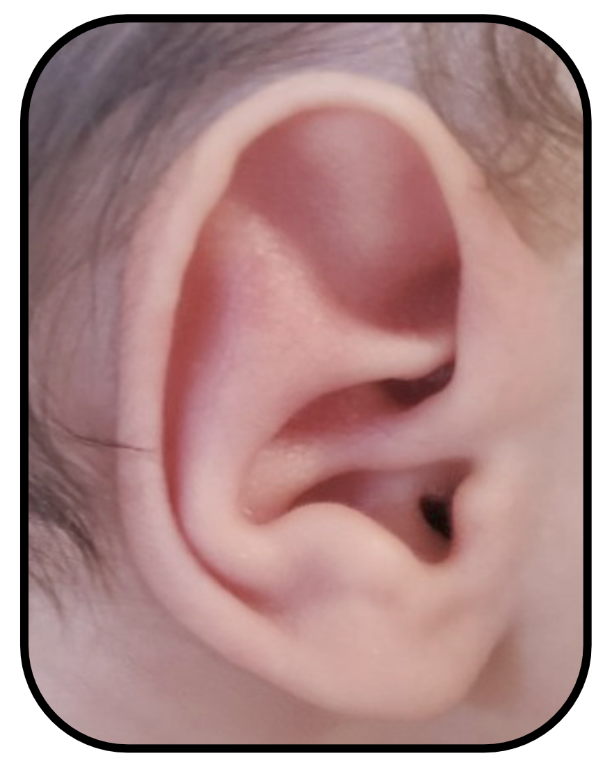 baby with stahls ear